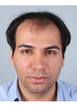 Before Hair Transplant&nbsp;Front